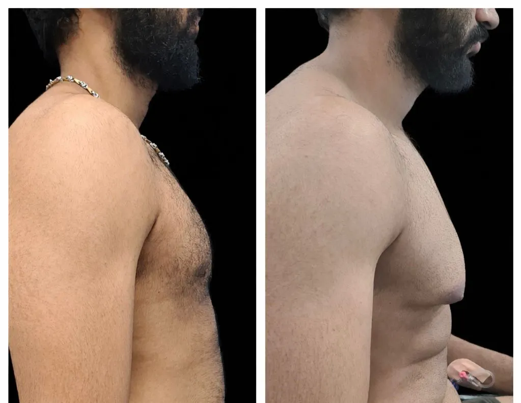 Gynecomastia Treatment In Baner